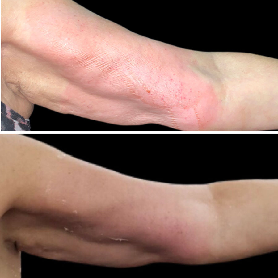 arm-before-and-after-co2lift